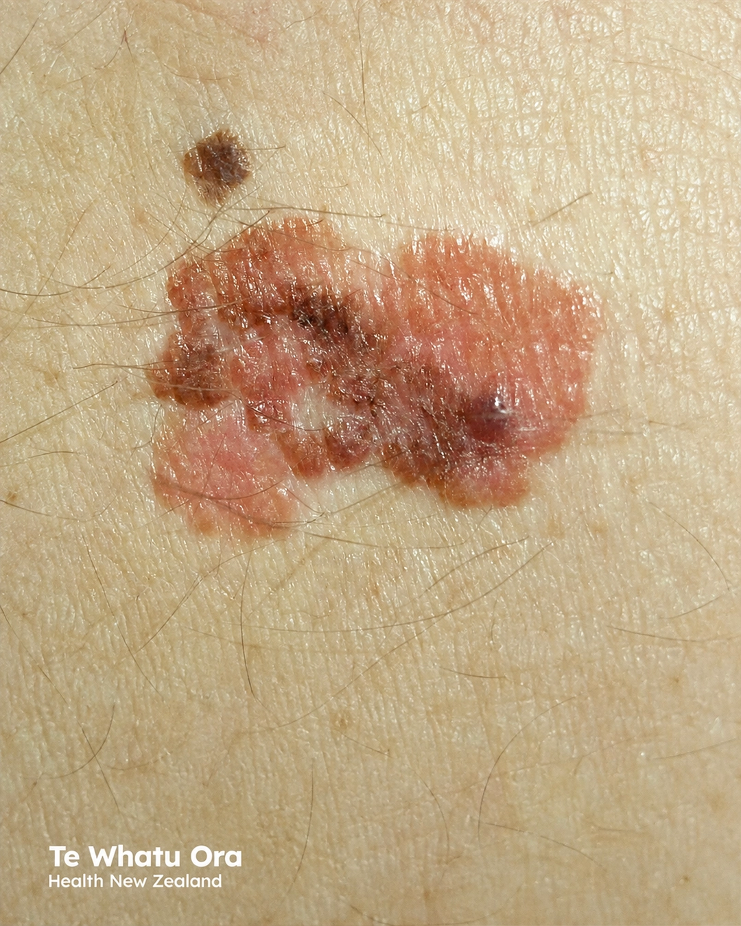 1.6 mm thick superficial spreading melanoma