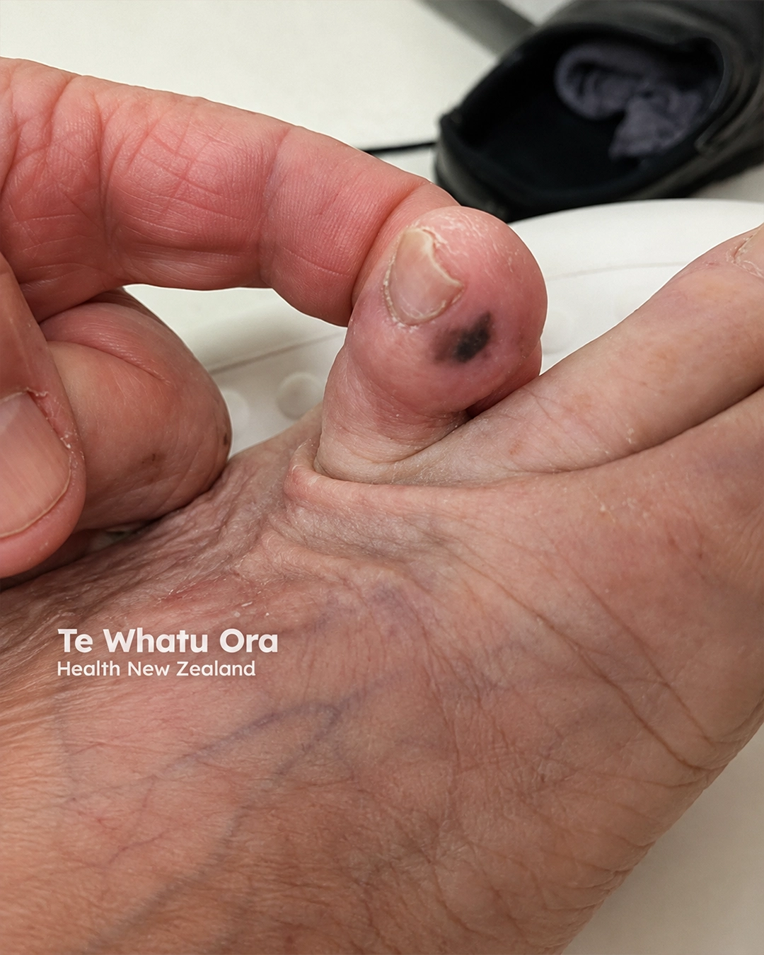 Acral lentiginous melanoma