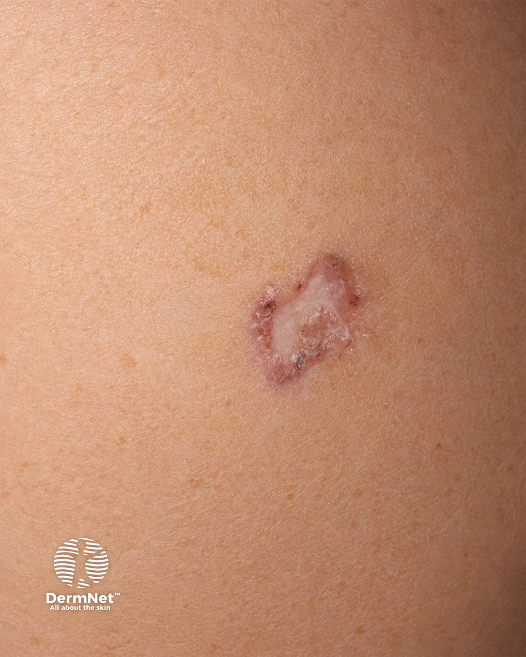 Amelanotic melanoma