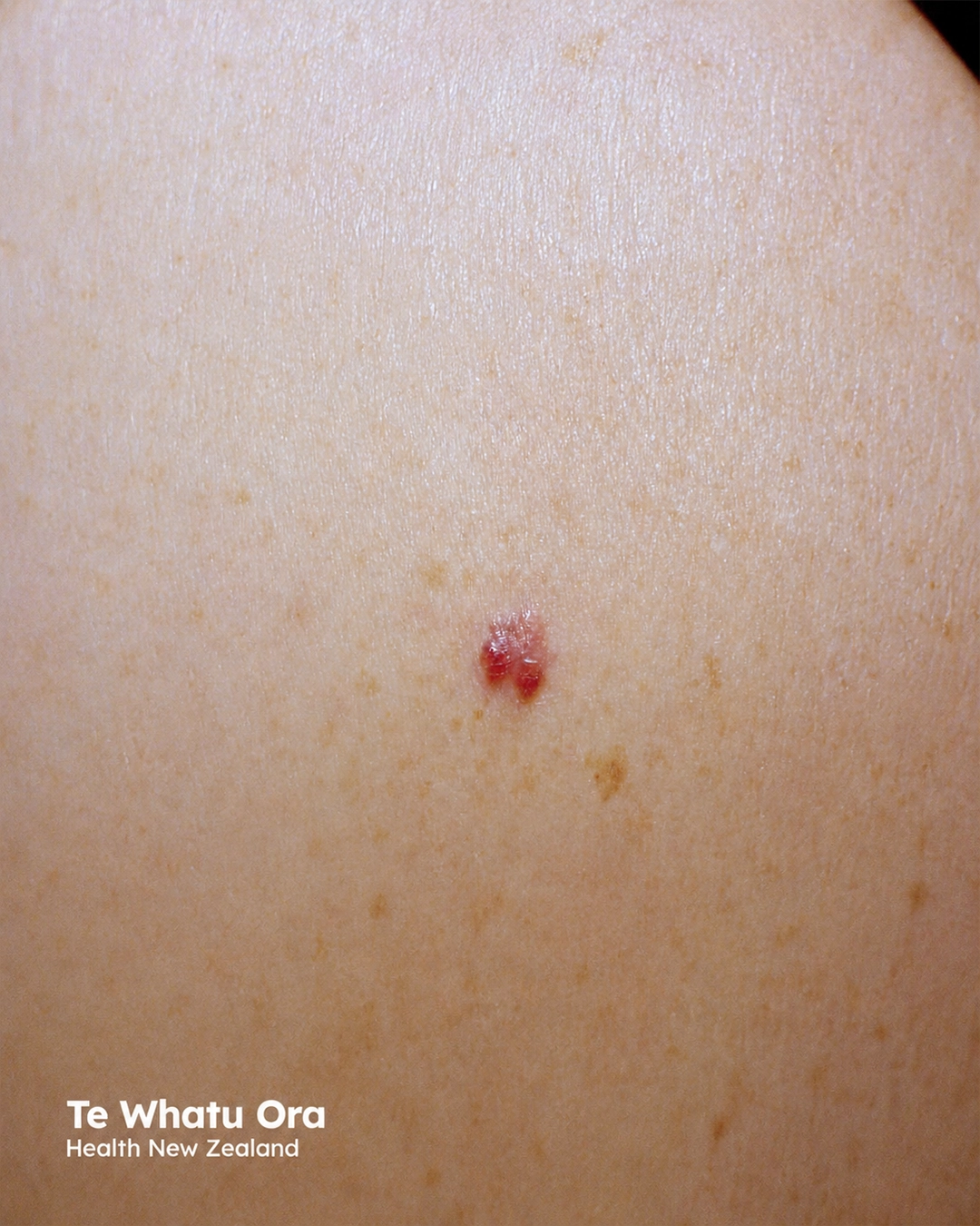 Amelanotic melanoma