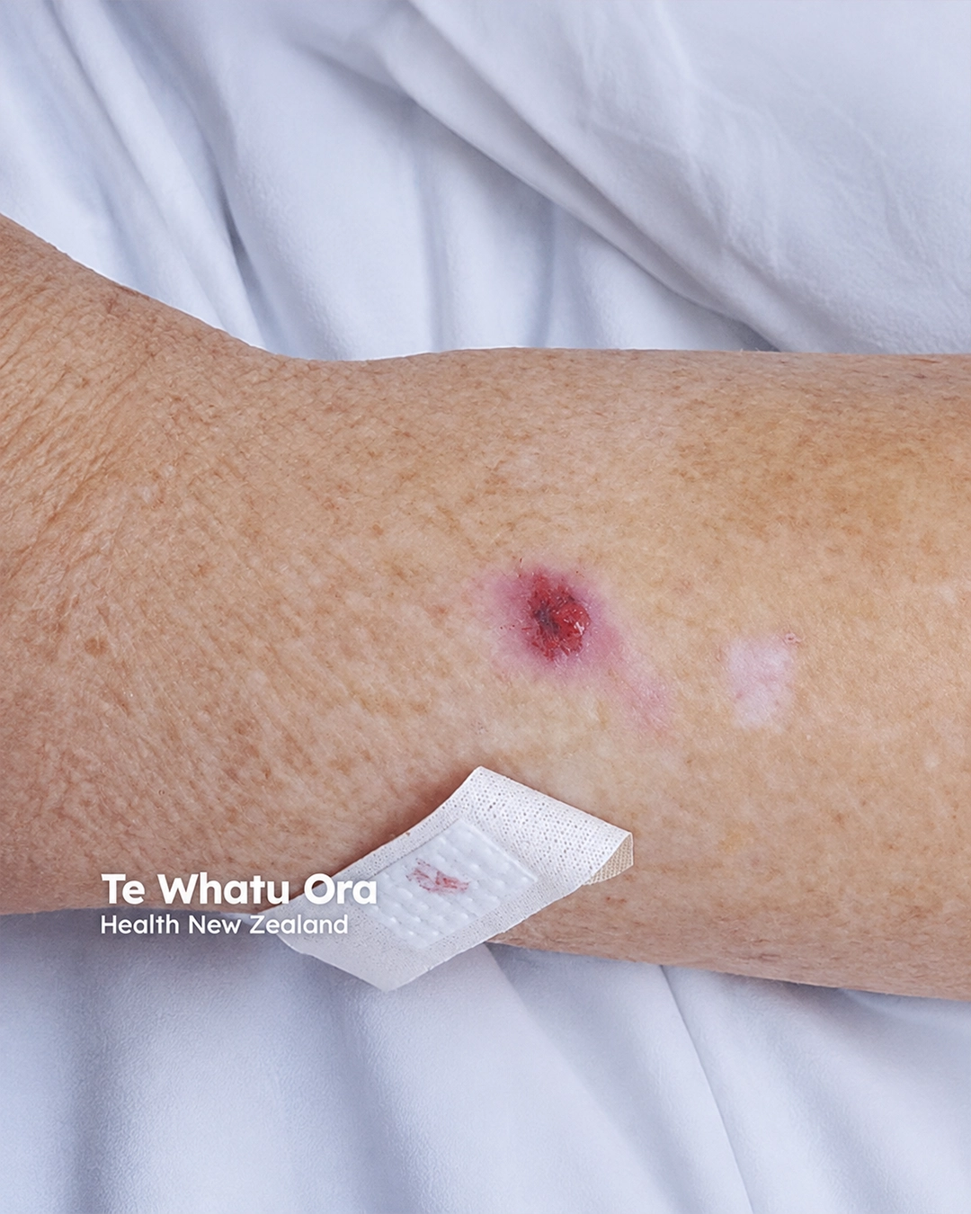 Amelanotic melanoma