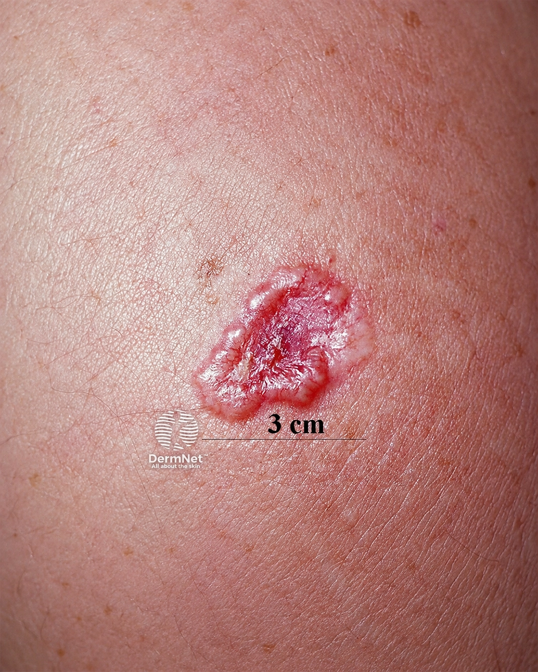 Basal Cell Carcinoma