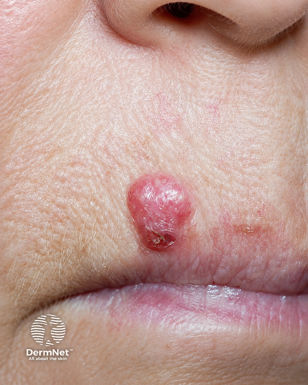 Basal cell carcinoma 2