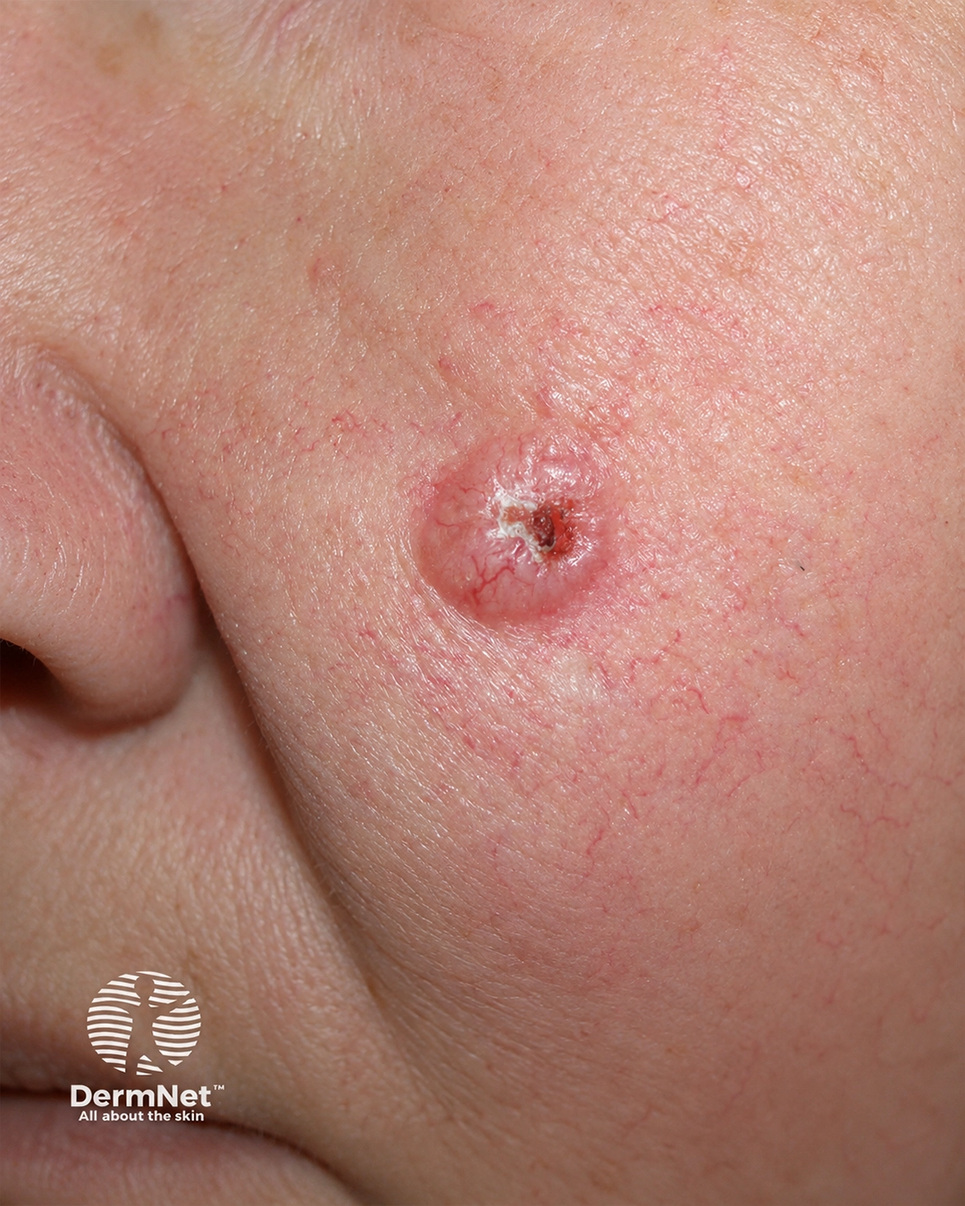 Basal cell carcinoma