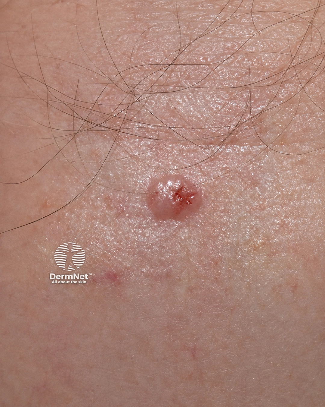 Basal cell carcinoma