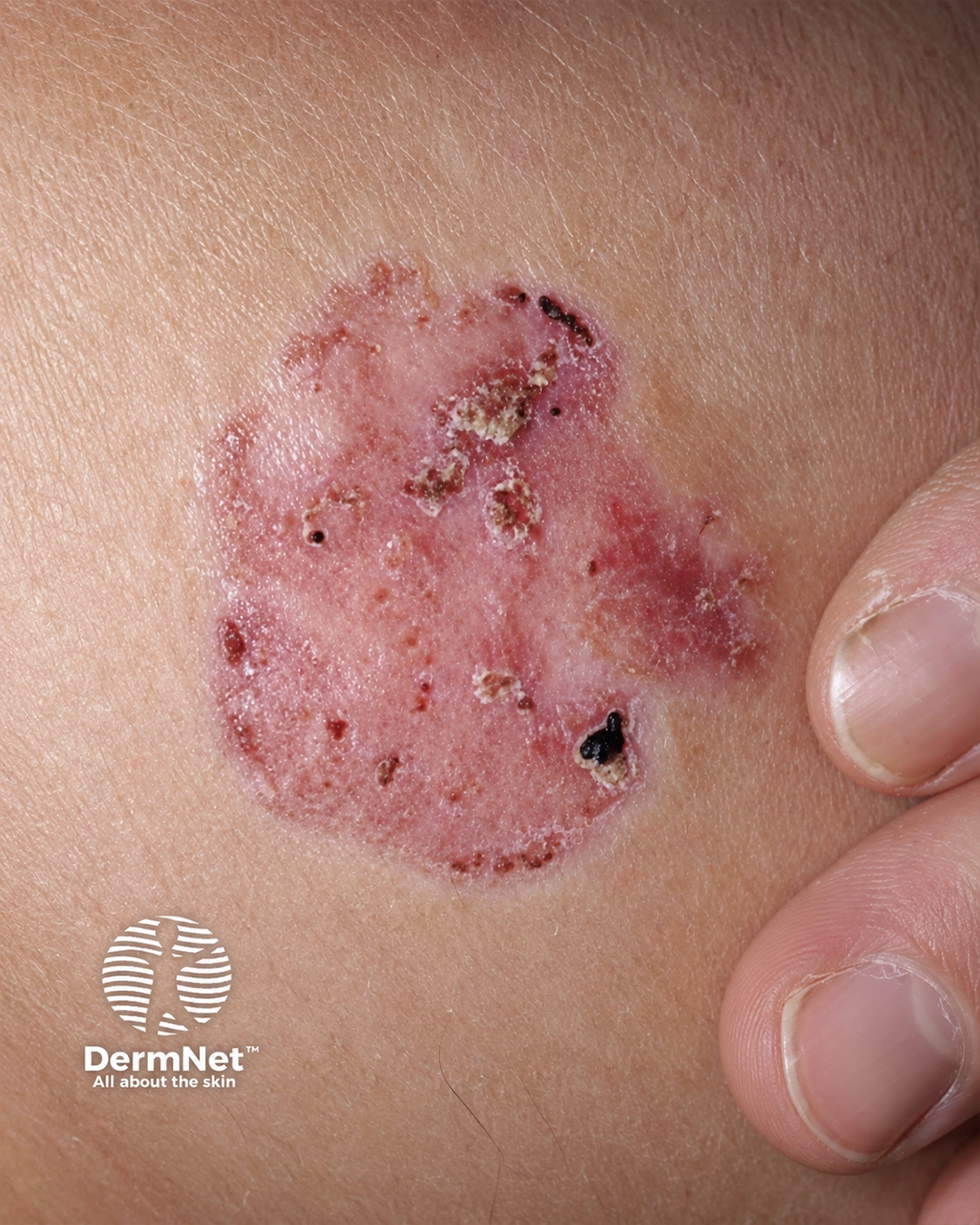 Basal cell carcinoma affecting the face