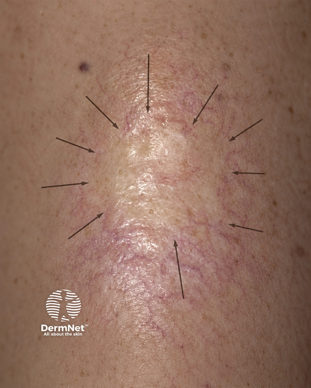 Basal cell carcinoma affecting the nose