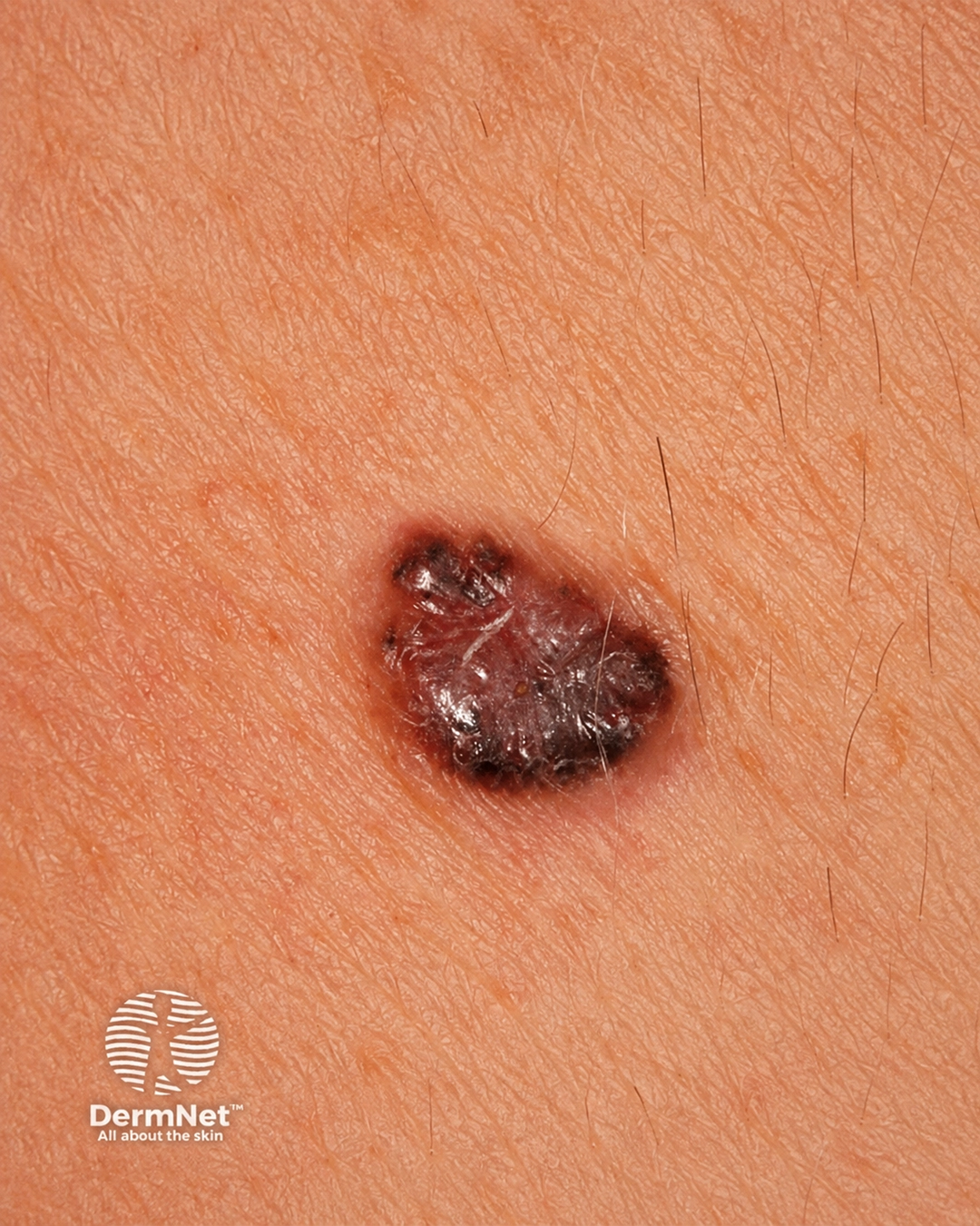 Basal cell carcinoma affecting the trunk