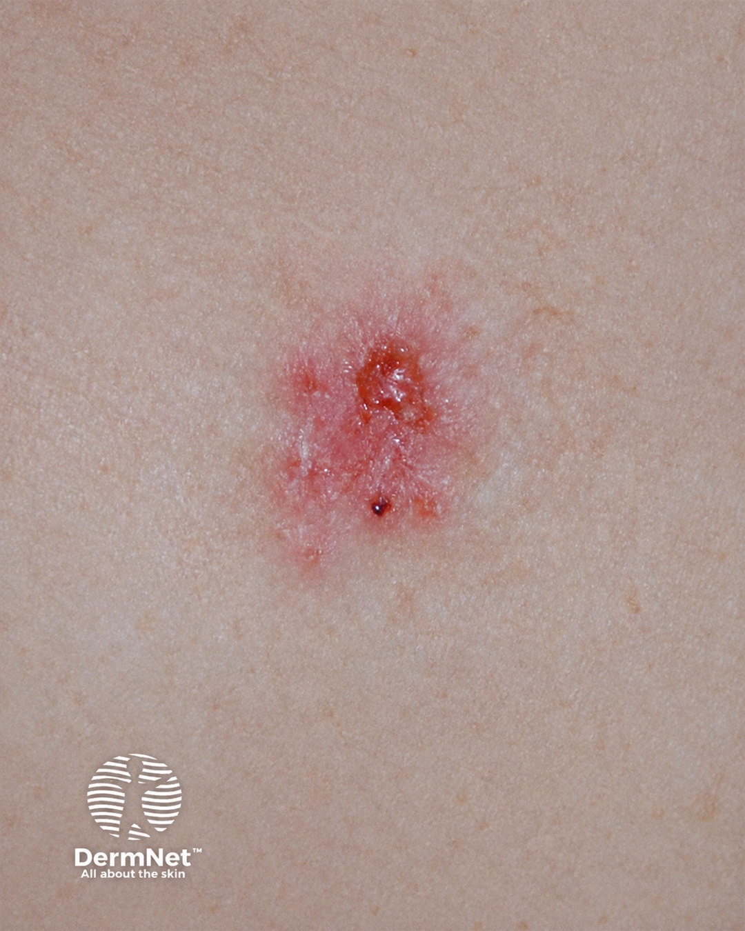 Basal cell carcinoma affecting the trunk