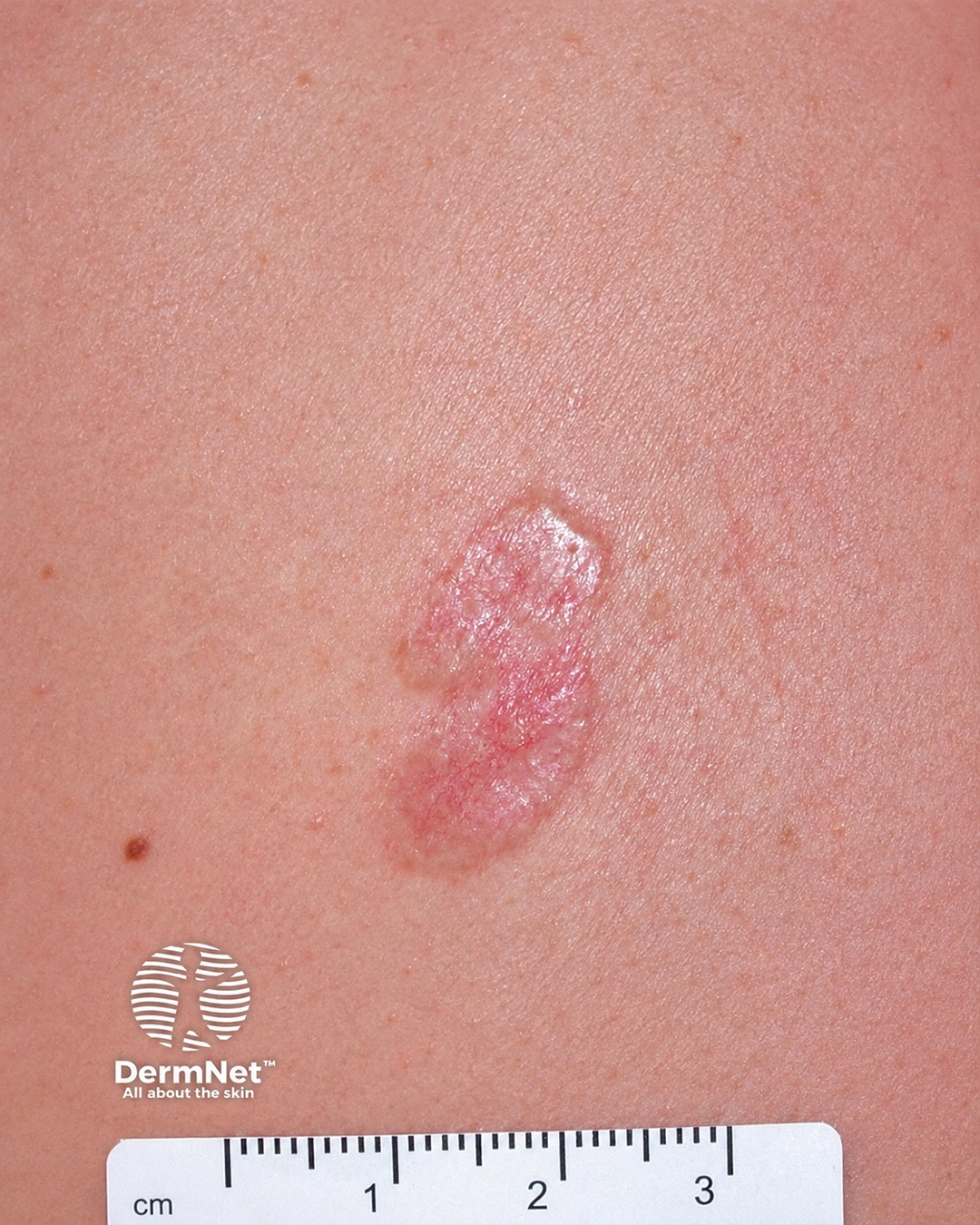 Basal cell carcinoma affecting the trunk 3