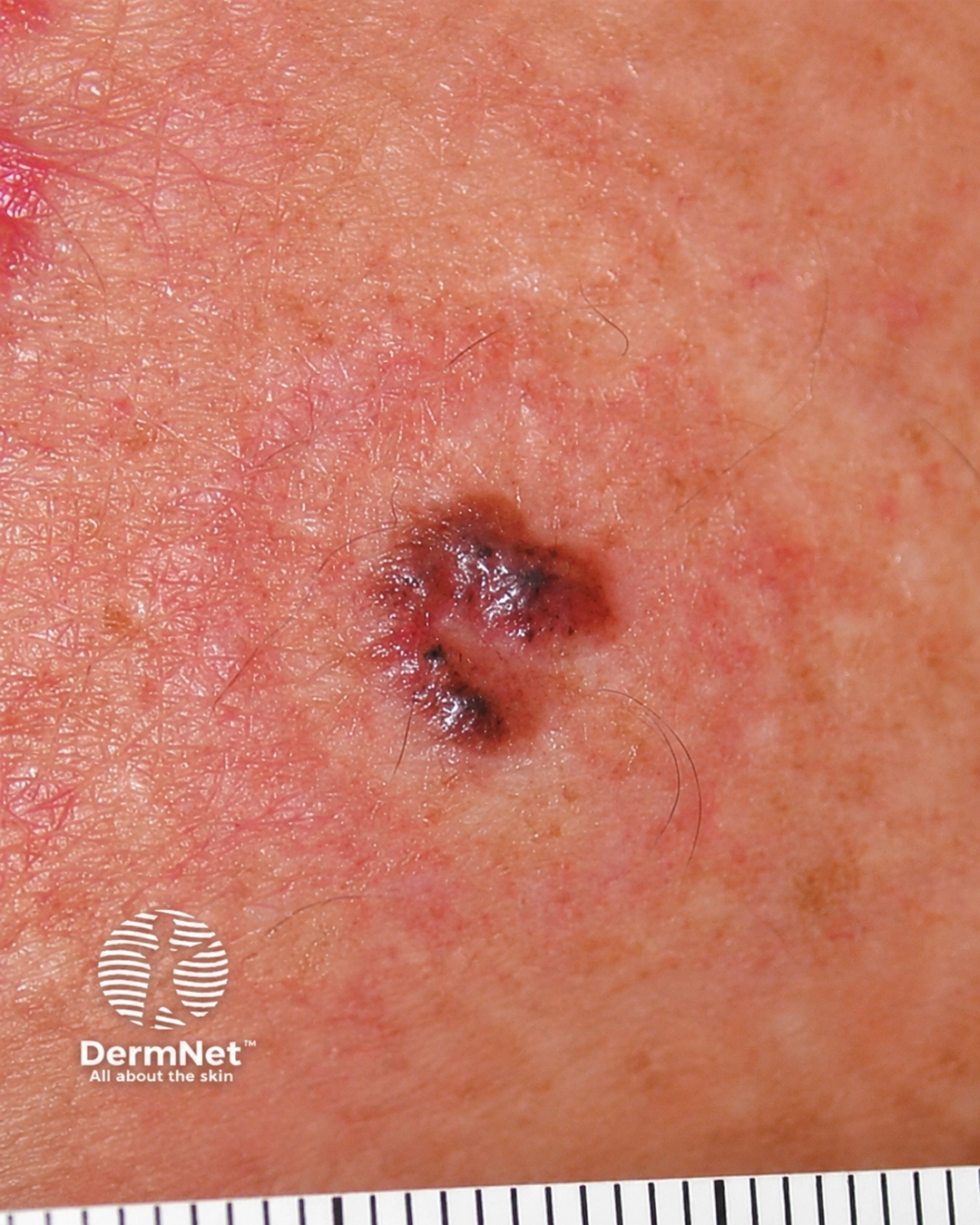 Basal cell carcinoma affecting the trunk