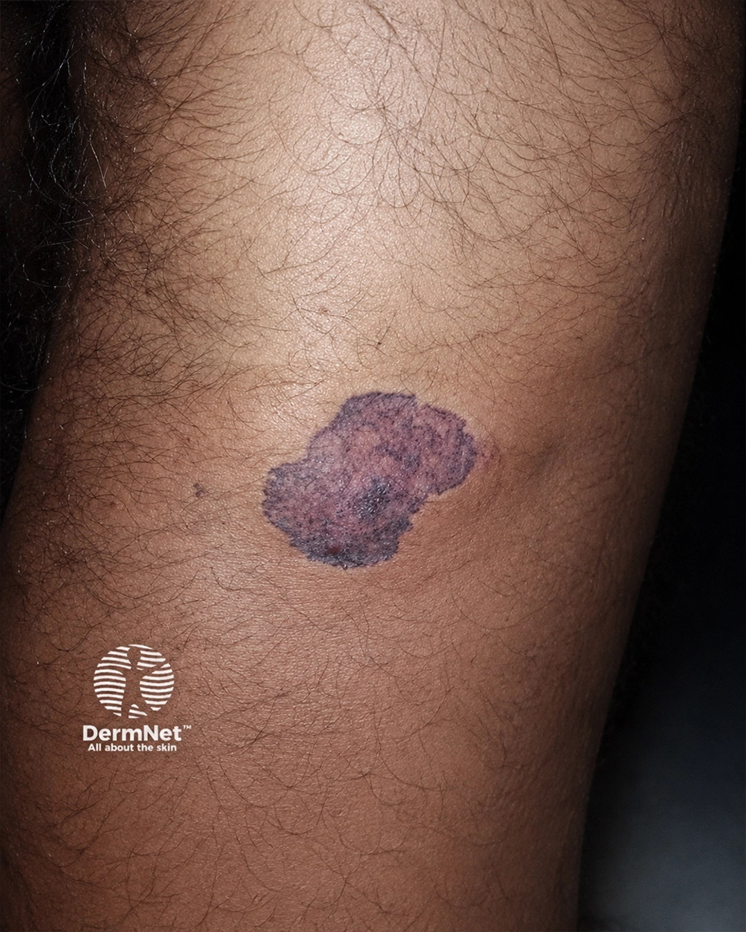 Basal cell carcinoma in skin of colour