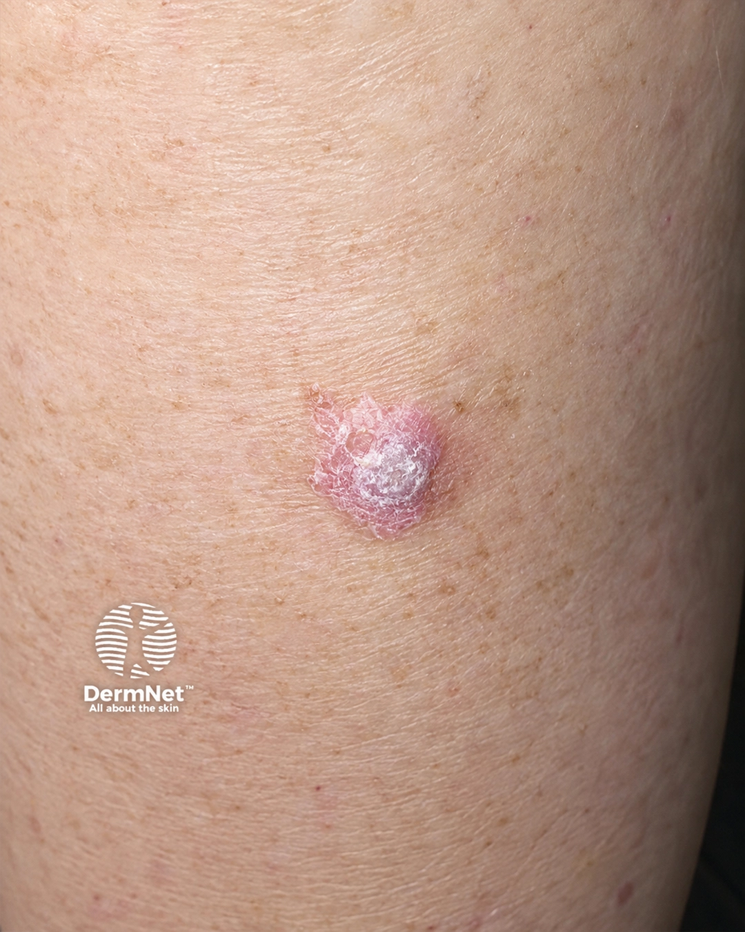 Cutaneous adverse drug reaction