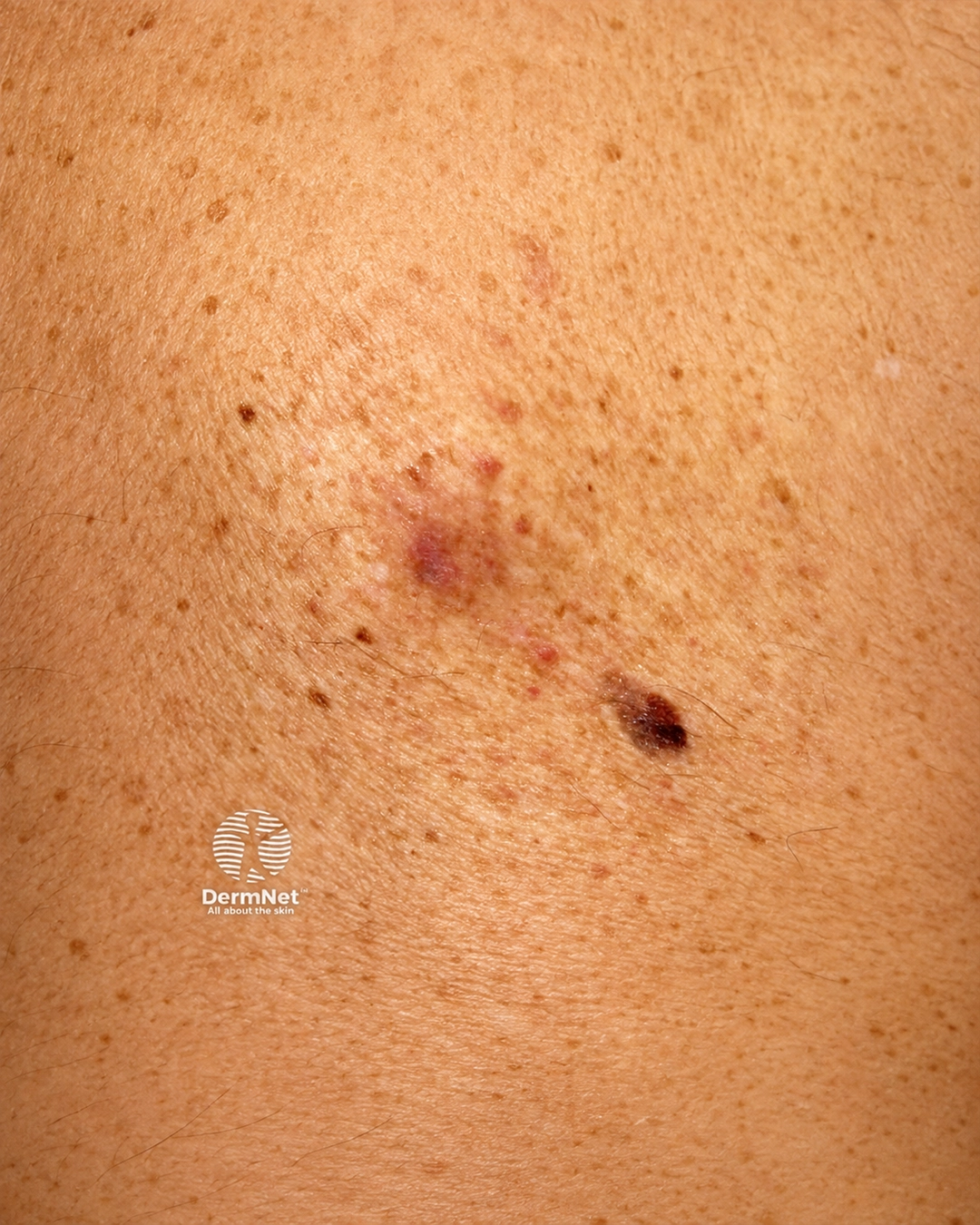 Desmoplastic melanoma