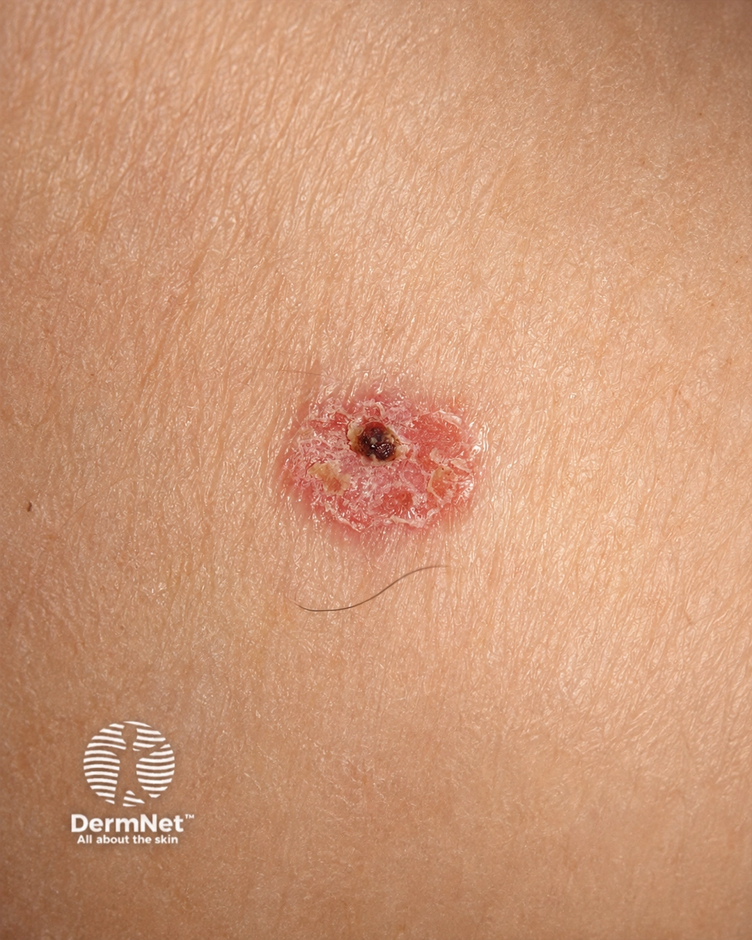 Intraepidermal carcinoma