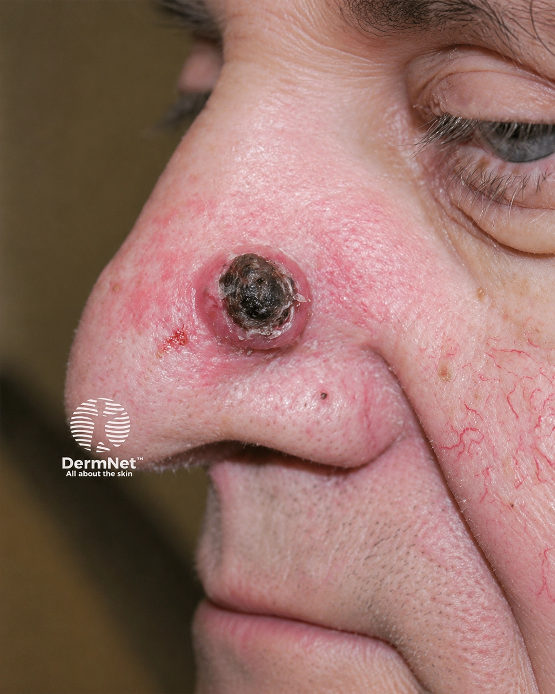 Keratoacanthoma
