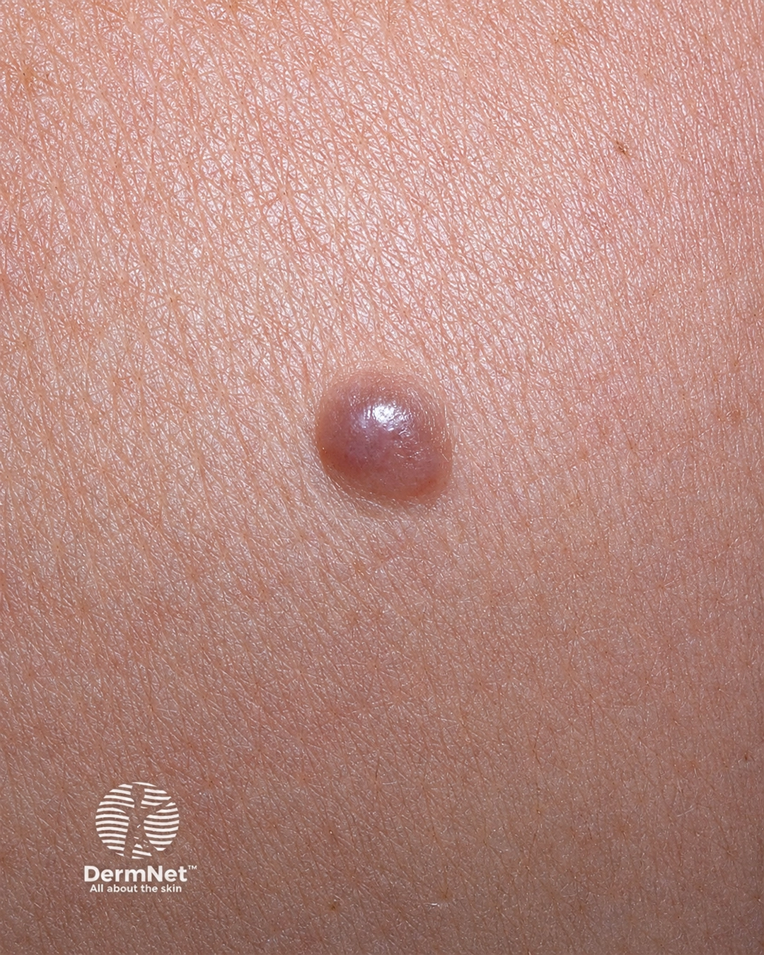 Melanoma