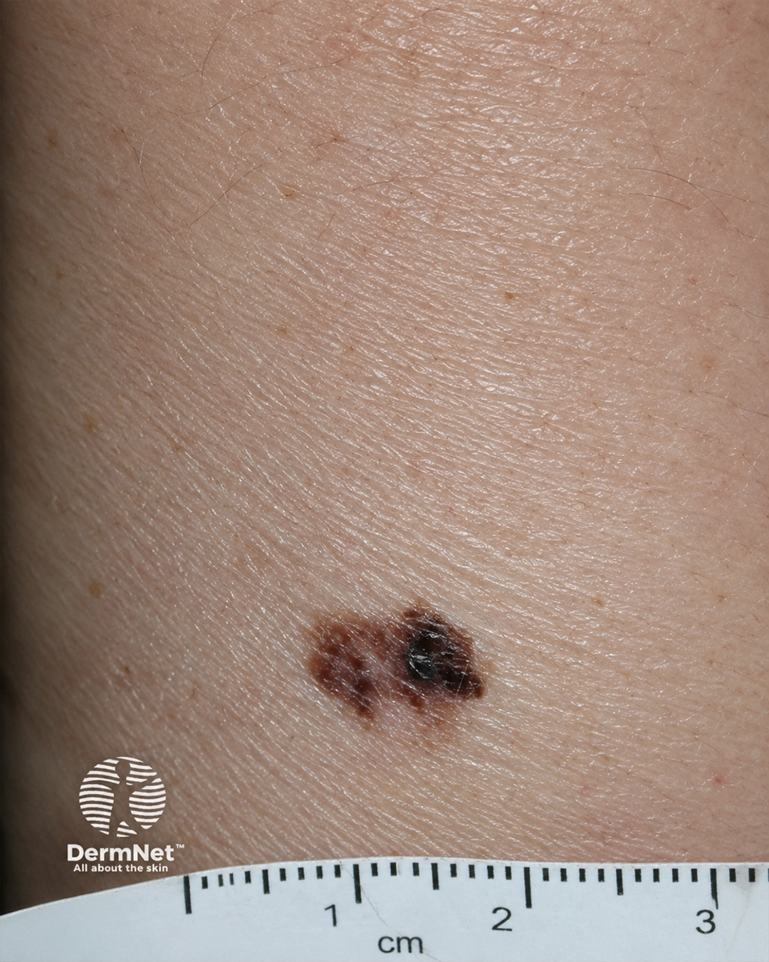 Melanoma 2