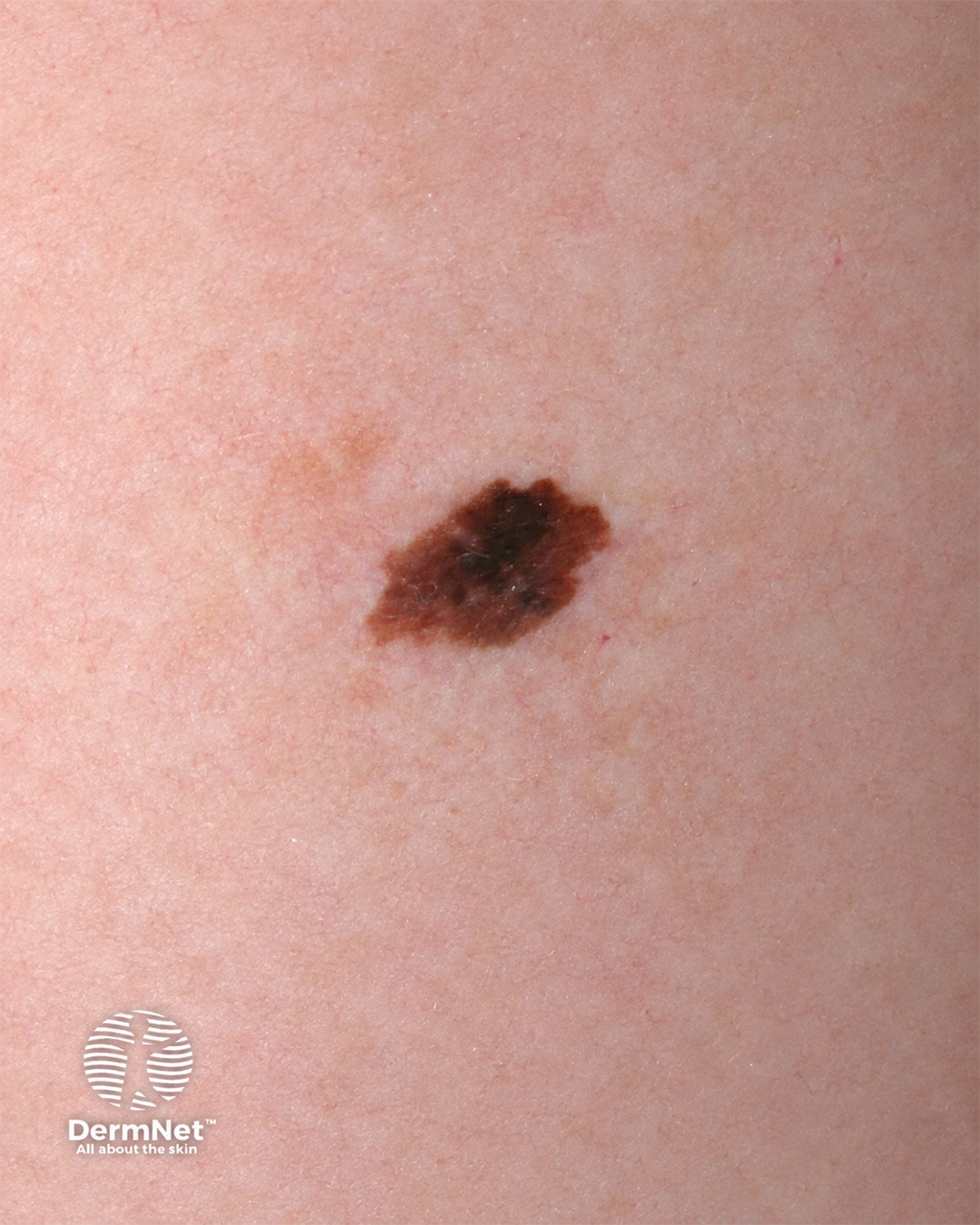 Melanoma in situ 8 macro