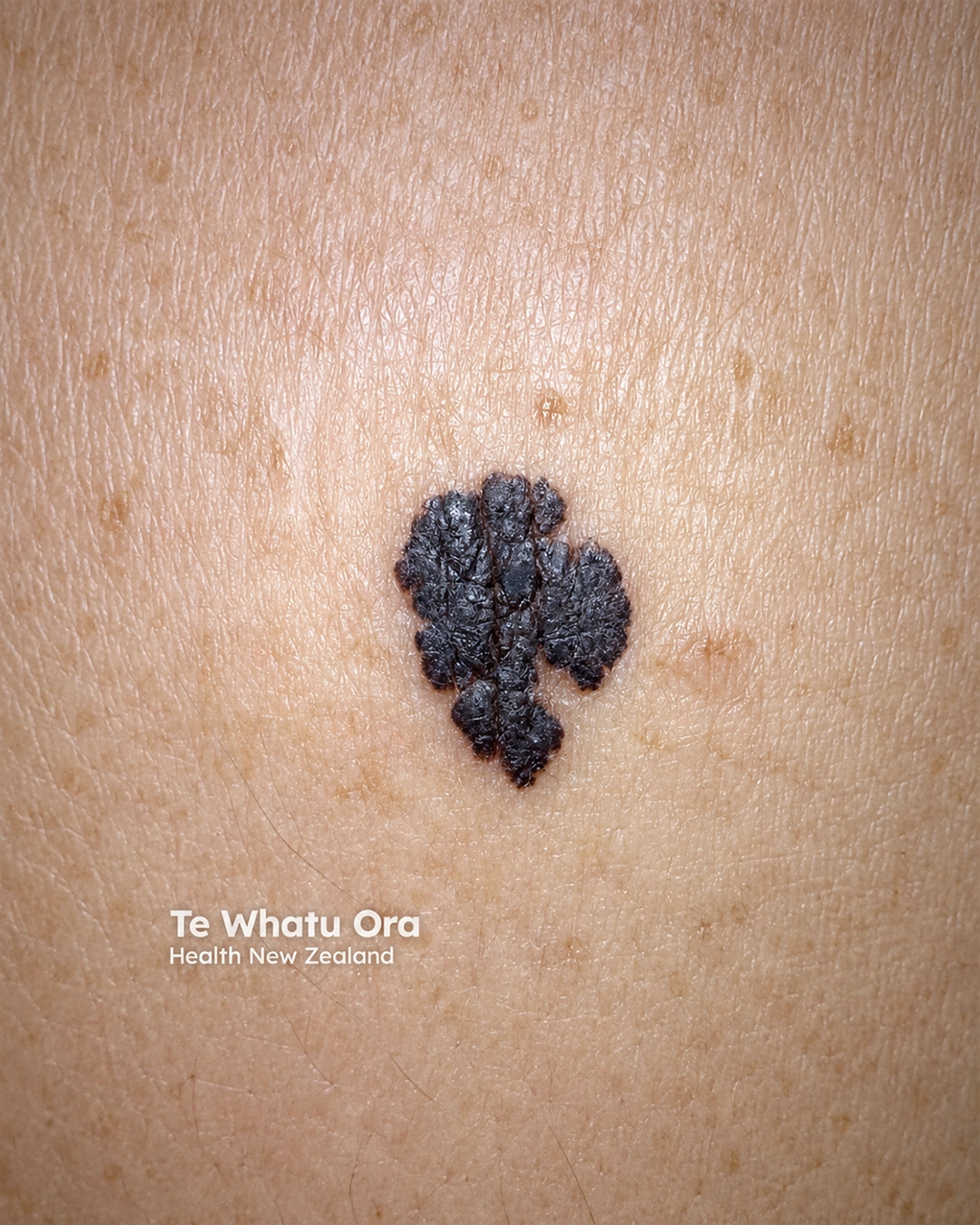 Melanoma
