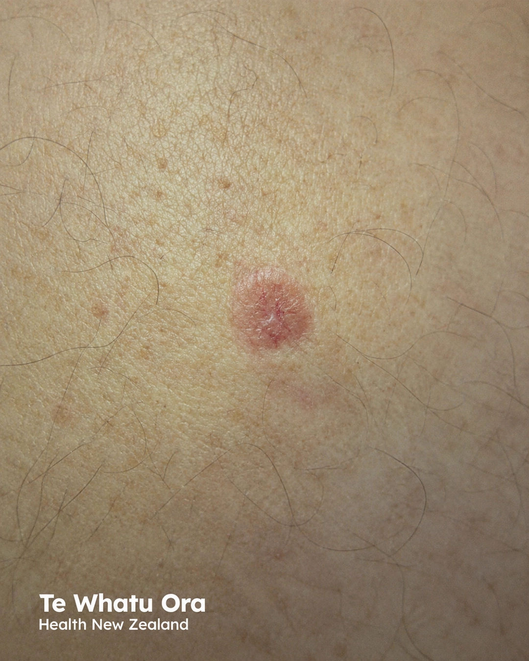 Nodular basal cell carcinoma, arm