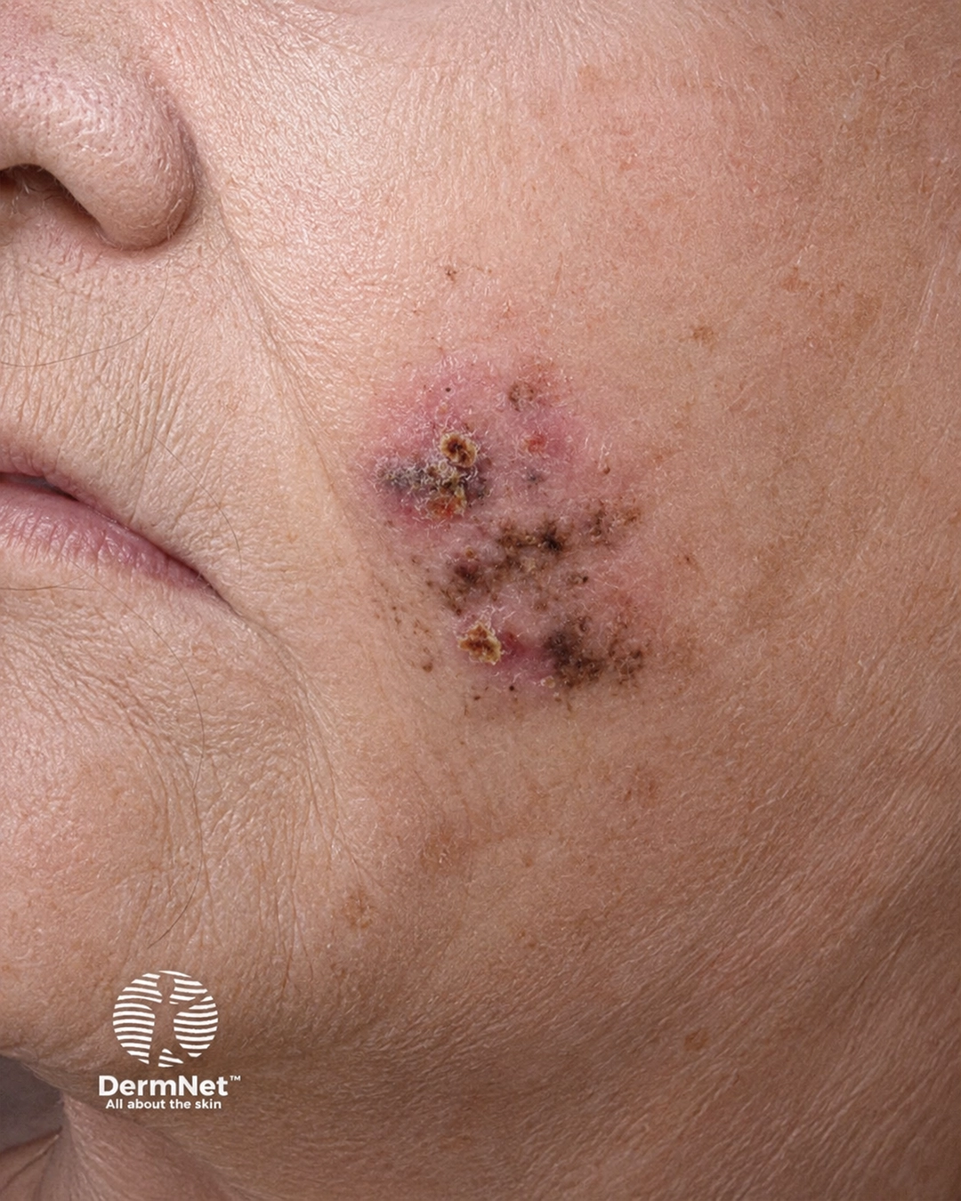 Nodular melanoma 7.5 mm arising in lentigo maligna meldanoma