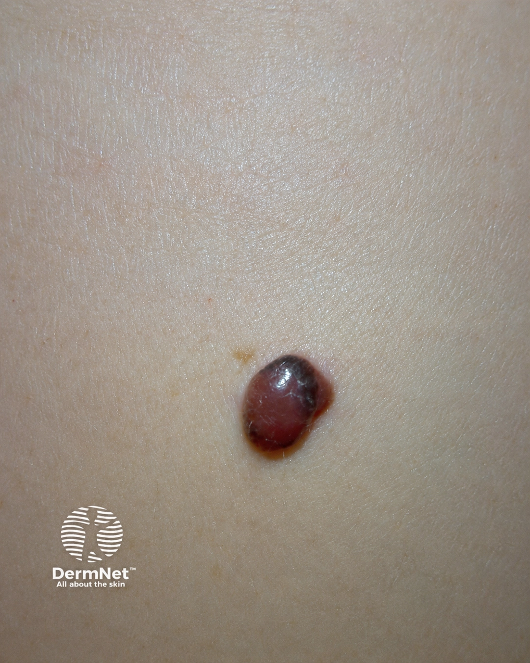 Nodular melanoma