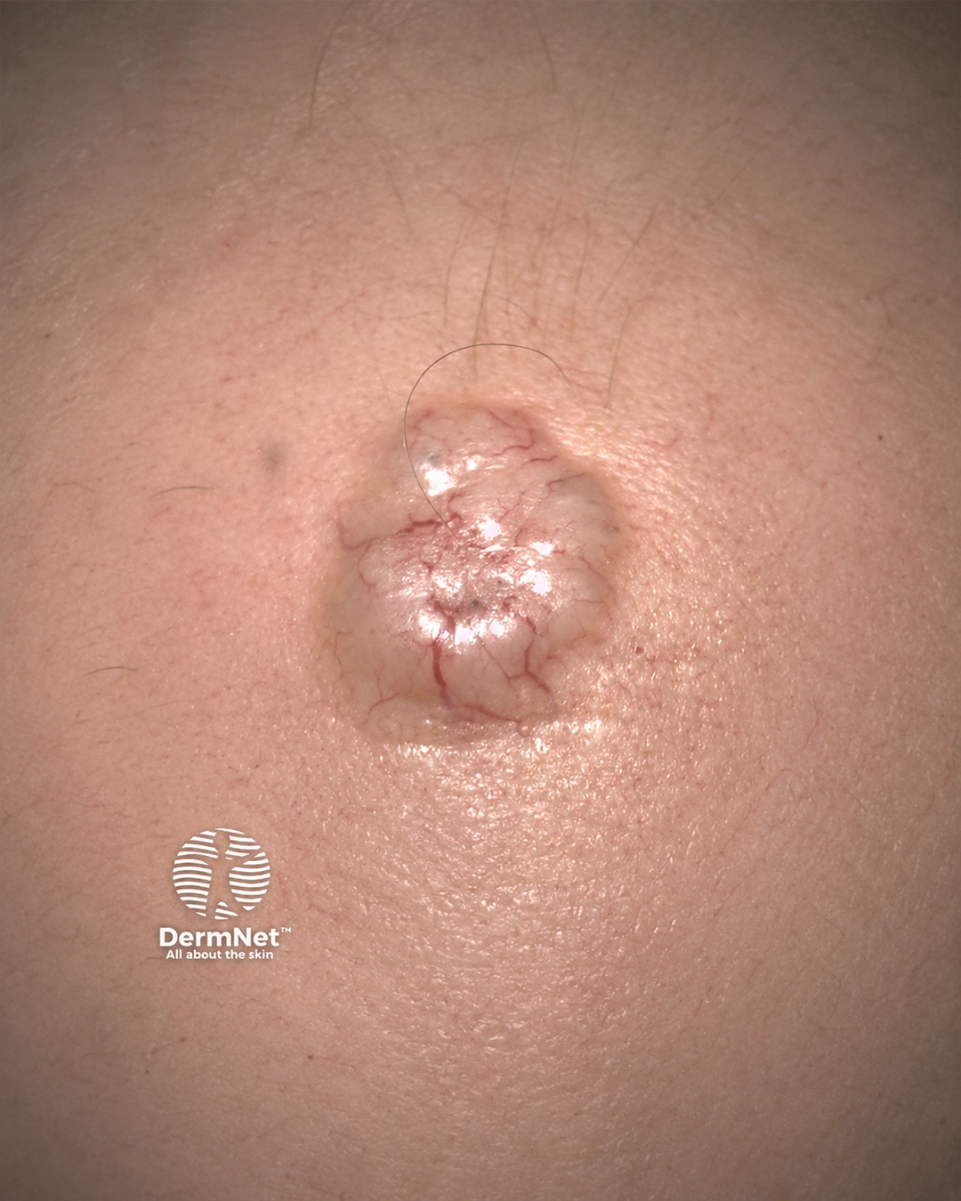 Nodulocystic basal cell carcinoma 2