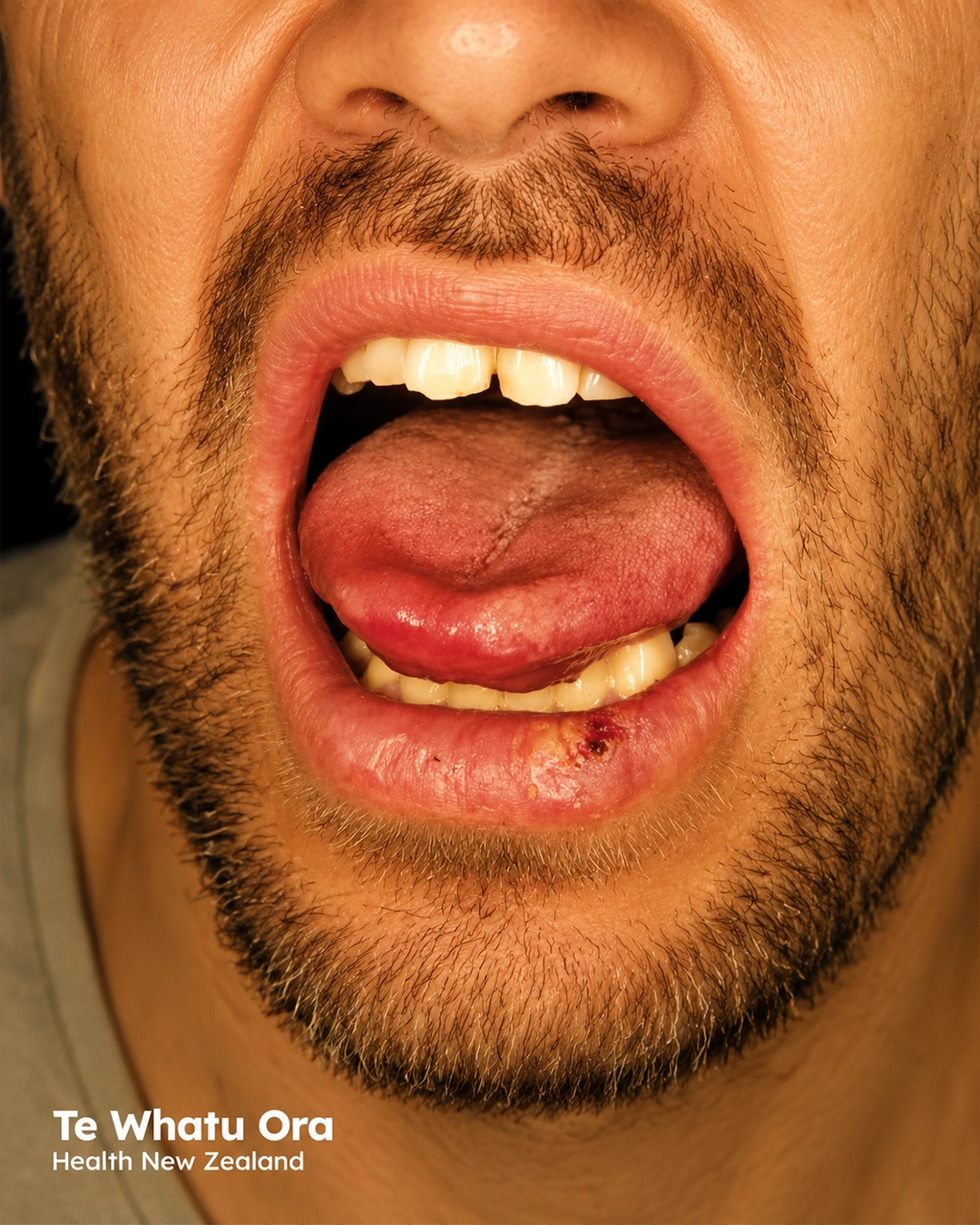 Oral squamous cell carcinoma