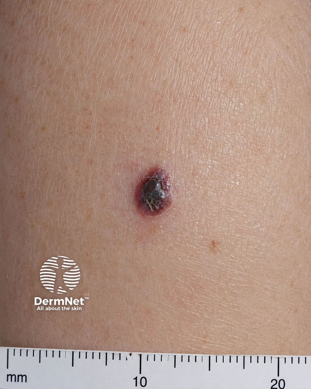 Pigmented melanoma