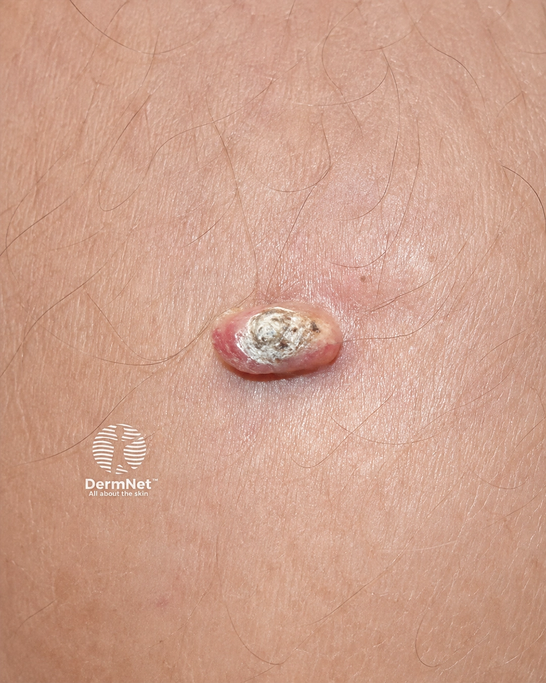 Squamous Cell Carcinoma