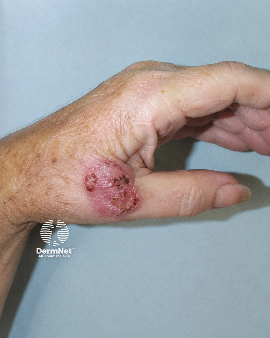 Squamous cell carcinoma