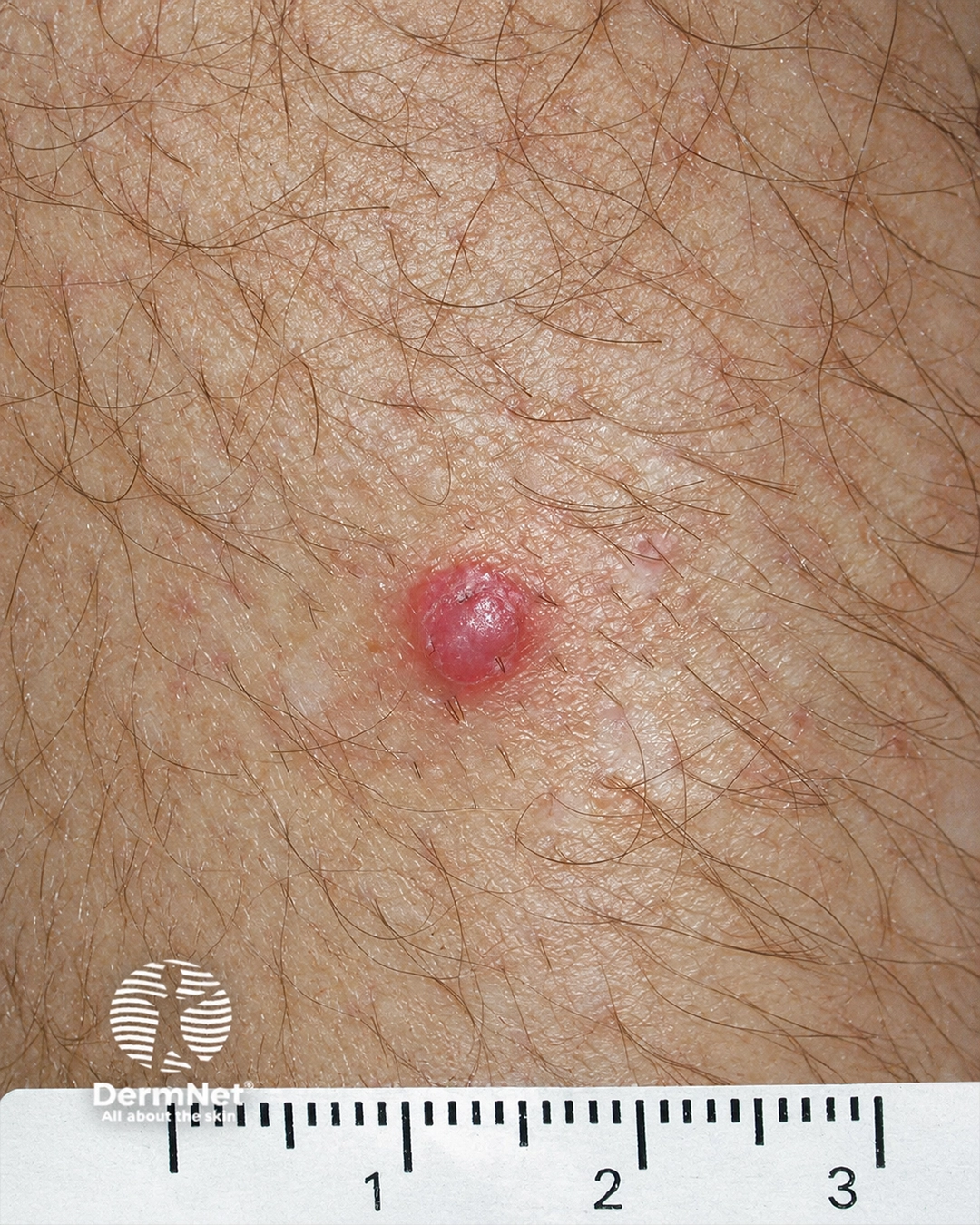 Squamous cell carcinoma of limbs