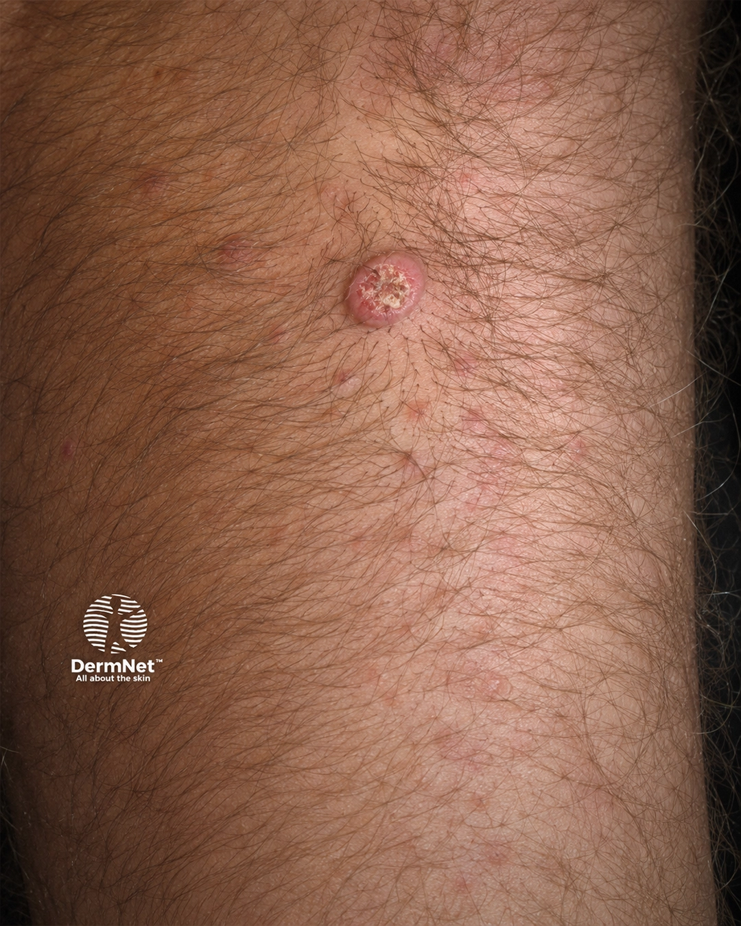 Squamous cell carcinoma of limbs