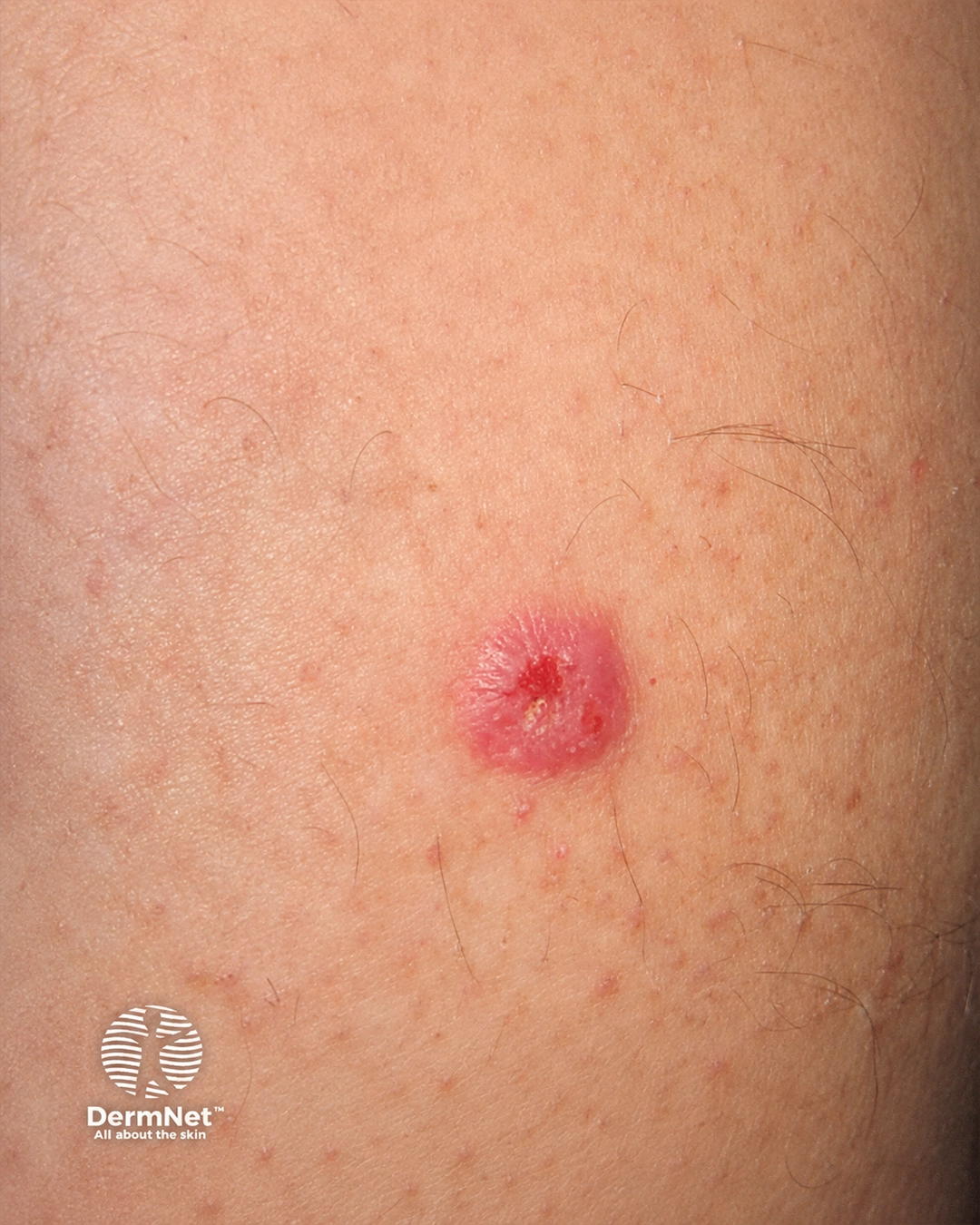 Squamous cell carcinoma of limbs