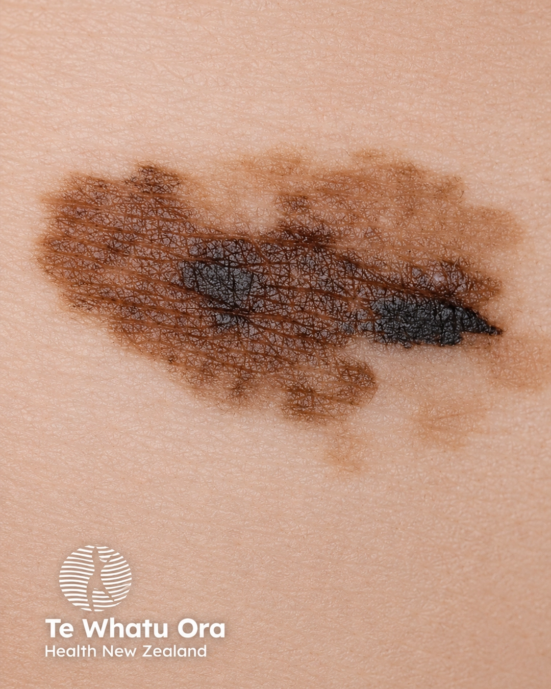 Superficial spreading melanoma