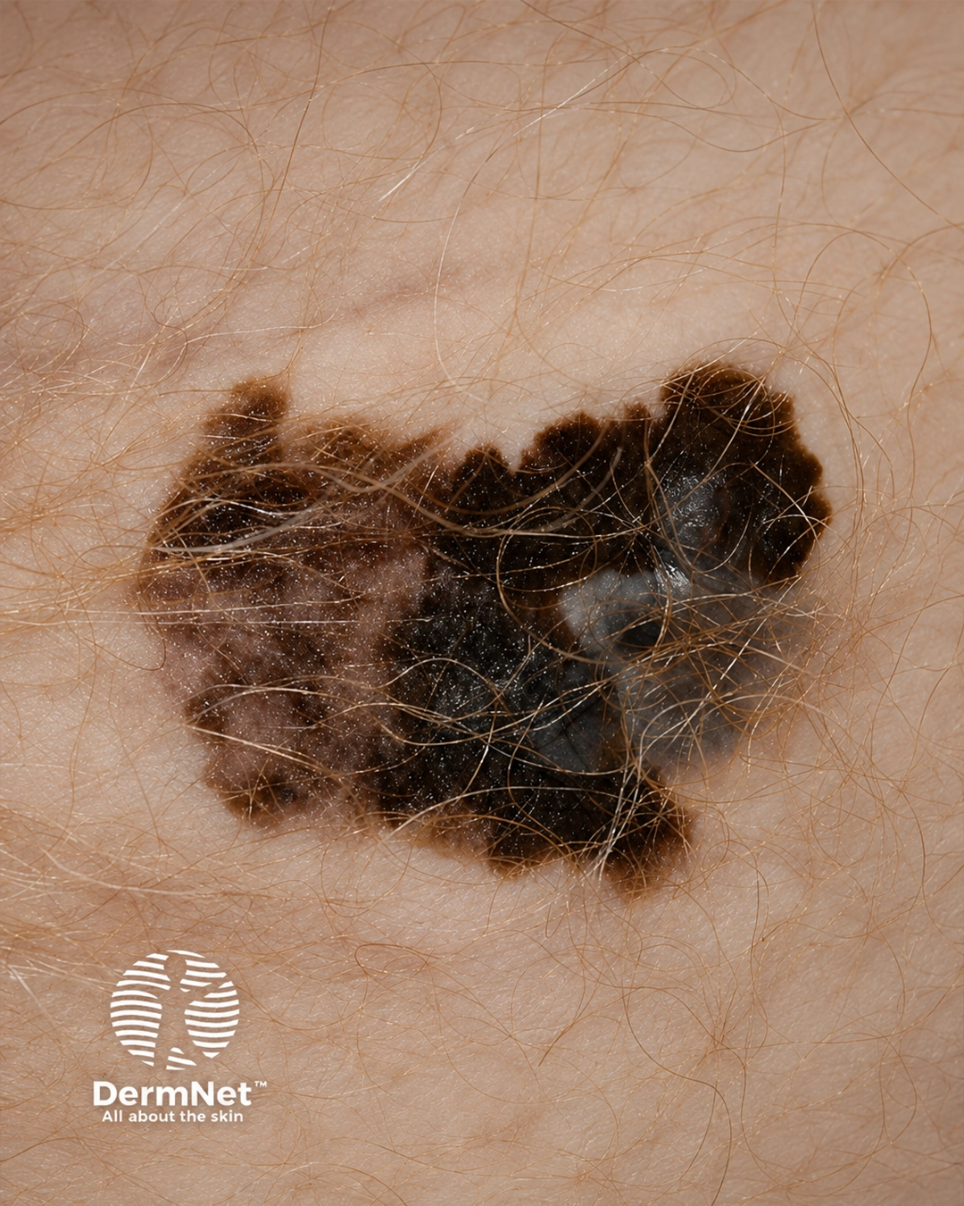 Superficial spreading melanoma 2
