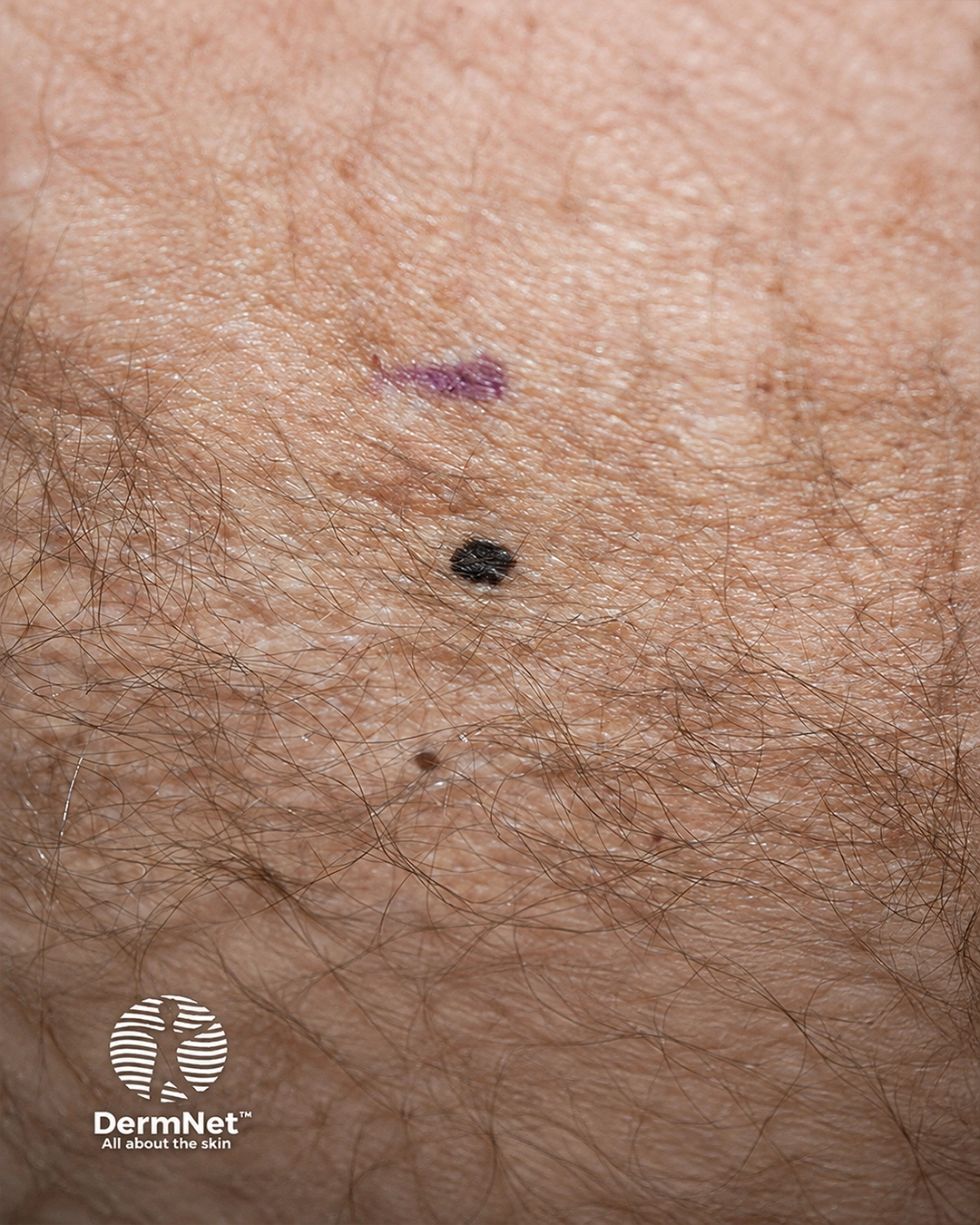 Superficial spreading melanoma -3