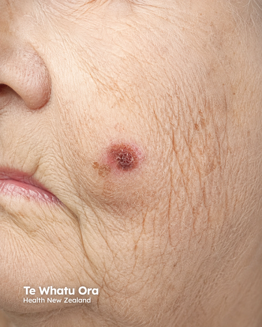 Superficial spreading melanoma