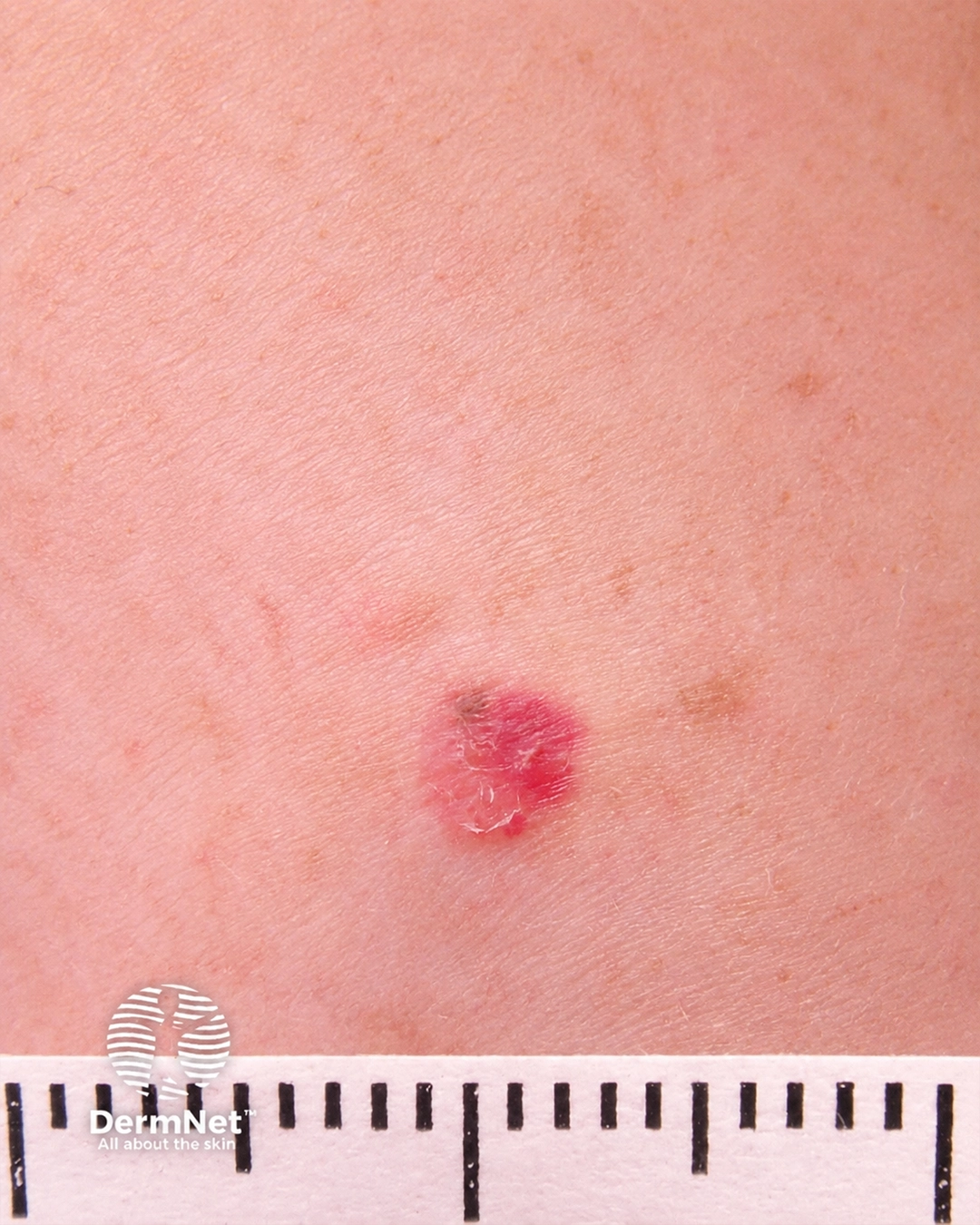 amelanotic-melanoma