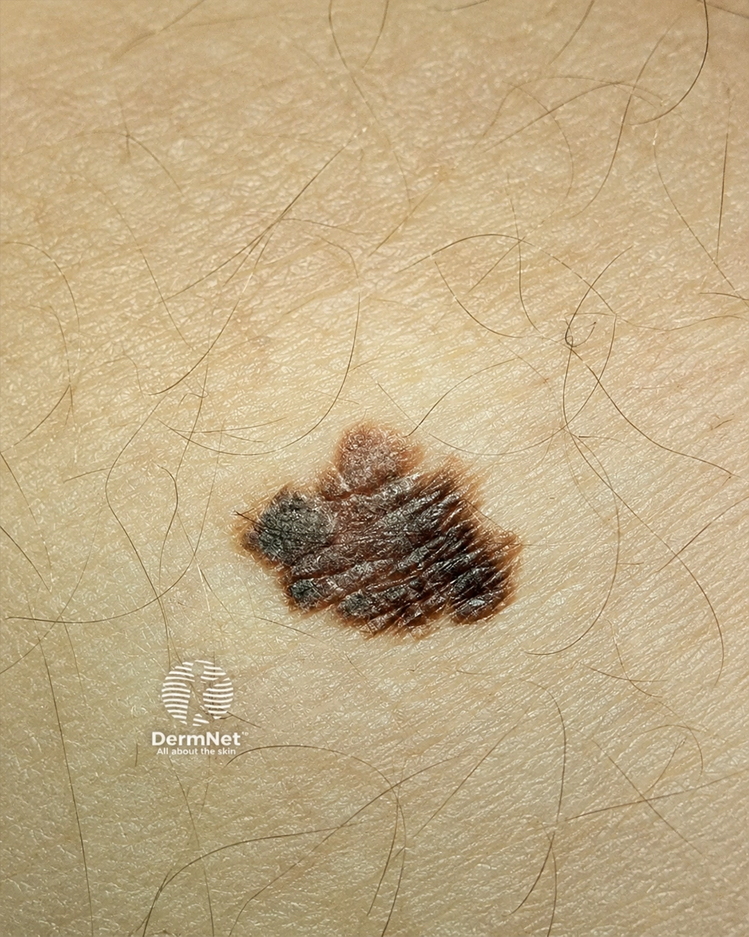 melanoma-in-situ