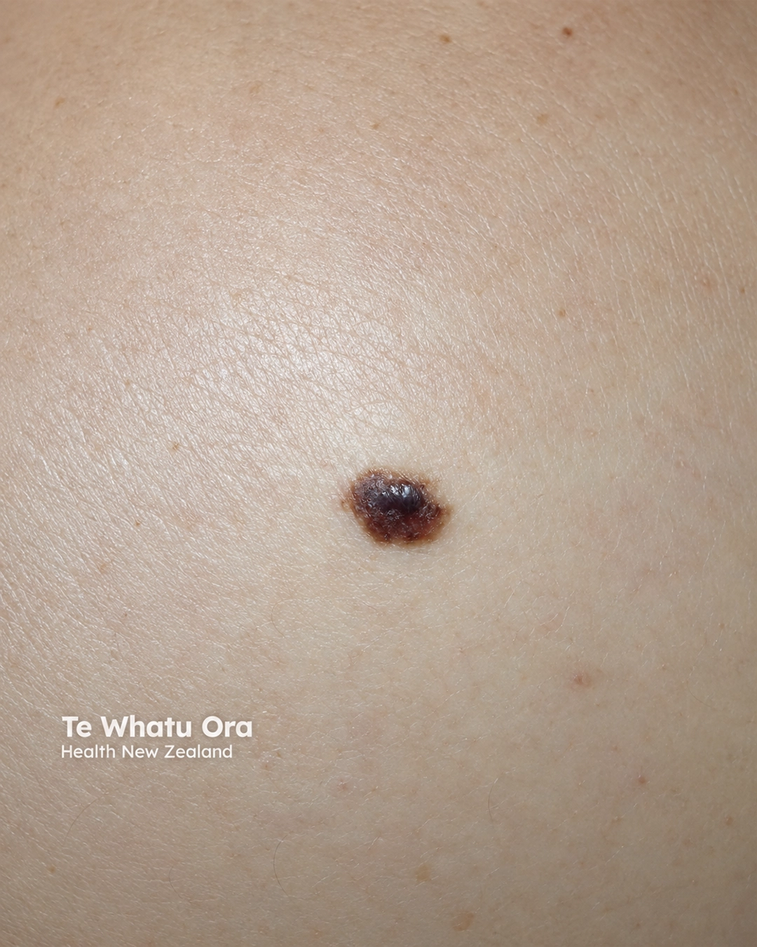 naevoid-melanoma